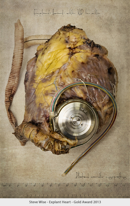 Wise_ExplantHeart_sm